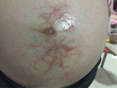 你那个还好 我这是肚皮裂开了 每晚都痒醒 天天把肚子露在外面 衣服一