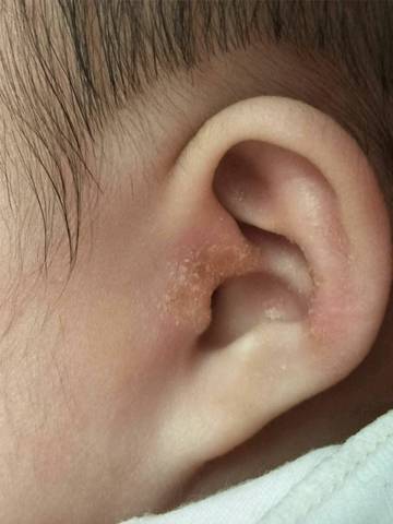 宝宝耳朵皮肤问题