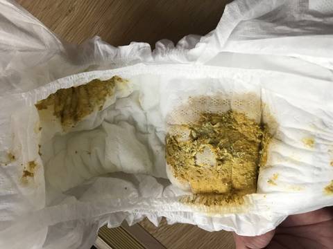 辛苦大家帮我看看臭臭,宝宝之前转奶没成功拉肚子给了腹泻奶粉,现在吃