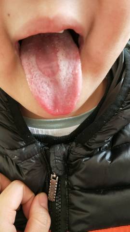 13岁女孩舌苔图片