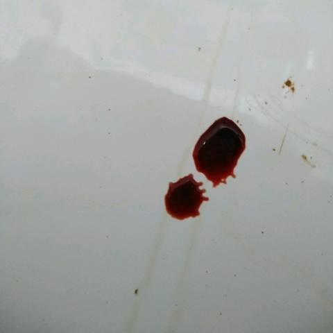 宫外孕出血的图片图片