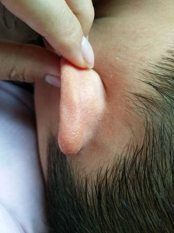 大宝的耳朵前几天好好的突然又红又肿,以为是被虫子咬了,就抹了点药