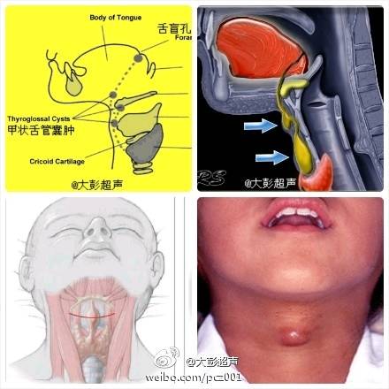 舌骨囊肿小孩图片