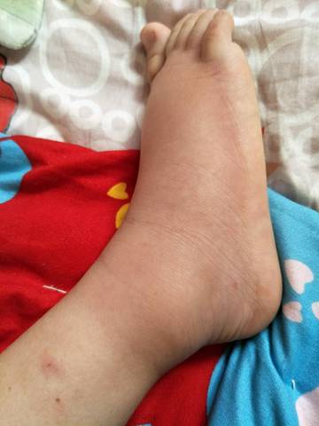 宝宝的脚踝突然肿了图图片