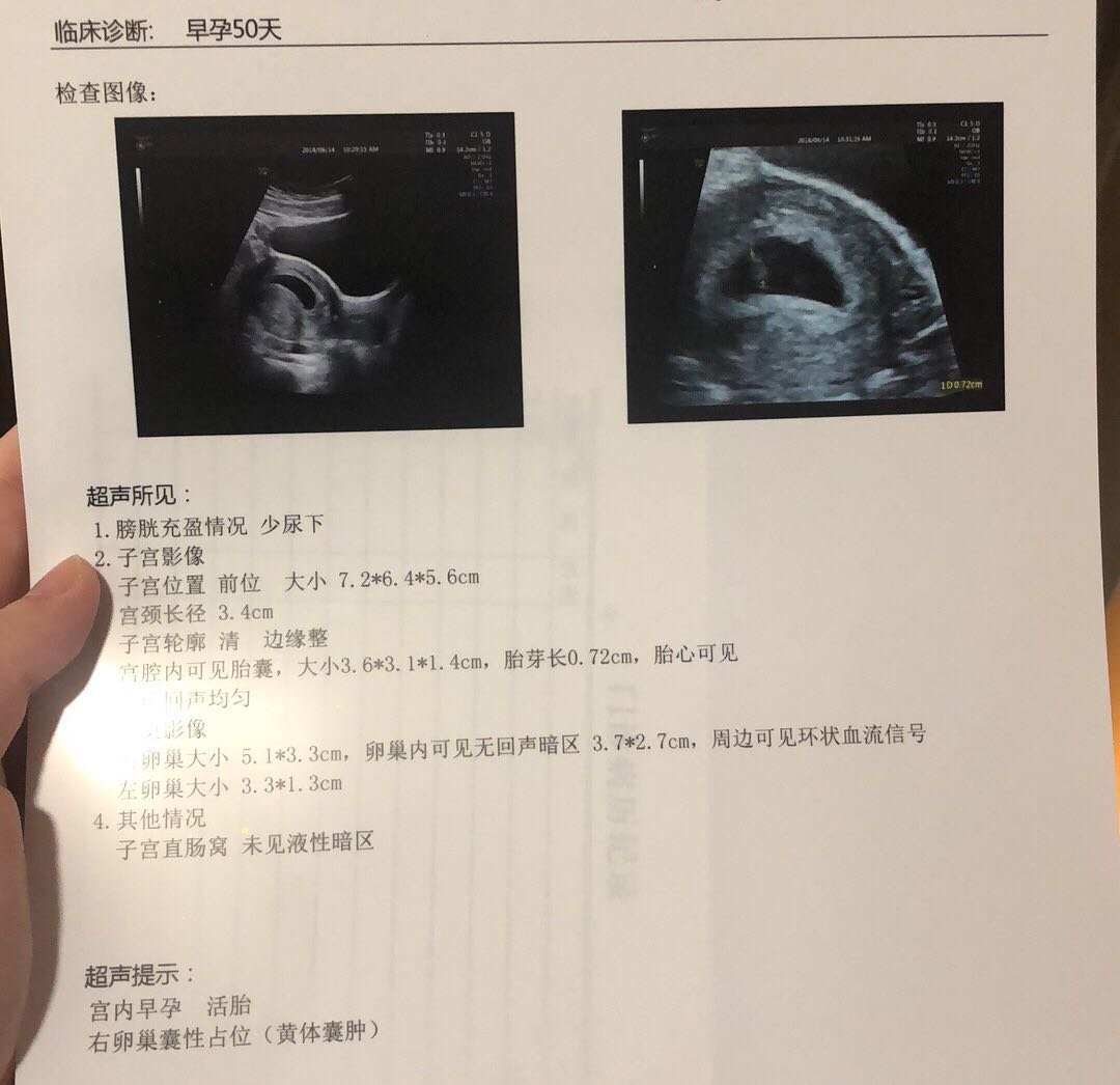 接胎心胎芽啦，像个小茄子