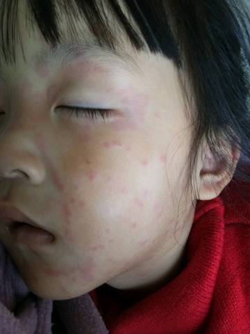 宝宝起荨麻疹的图片图片