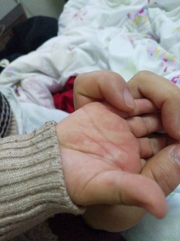 宝宝两周岁,今天发现手掌变成这样,摸着不硬,很痒,小孩老是抓,是冻疮