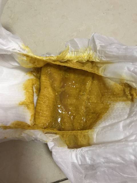 宝宝的大便正常吗?(有图慎入)_宝宝拉肚子很久了,吃过药看过_宝宝树