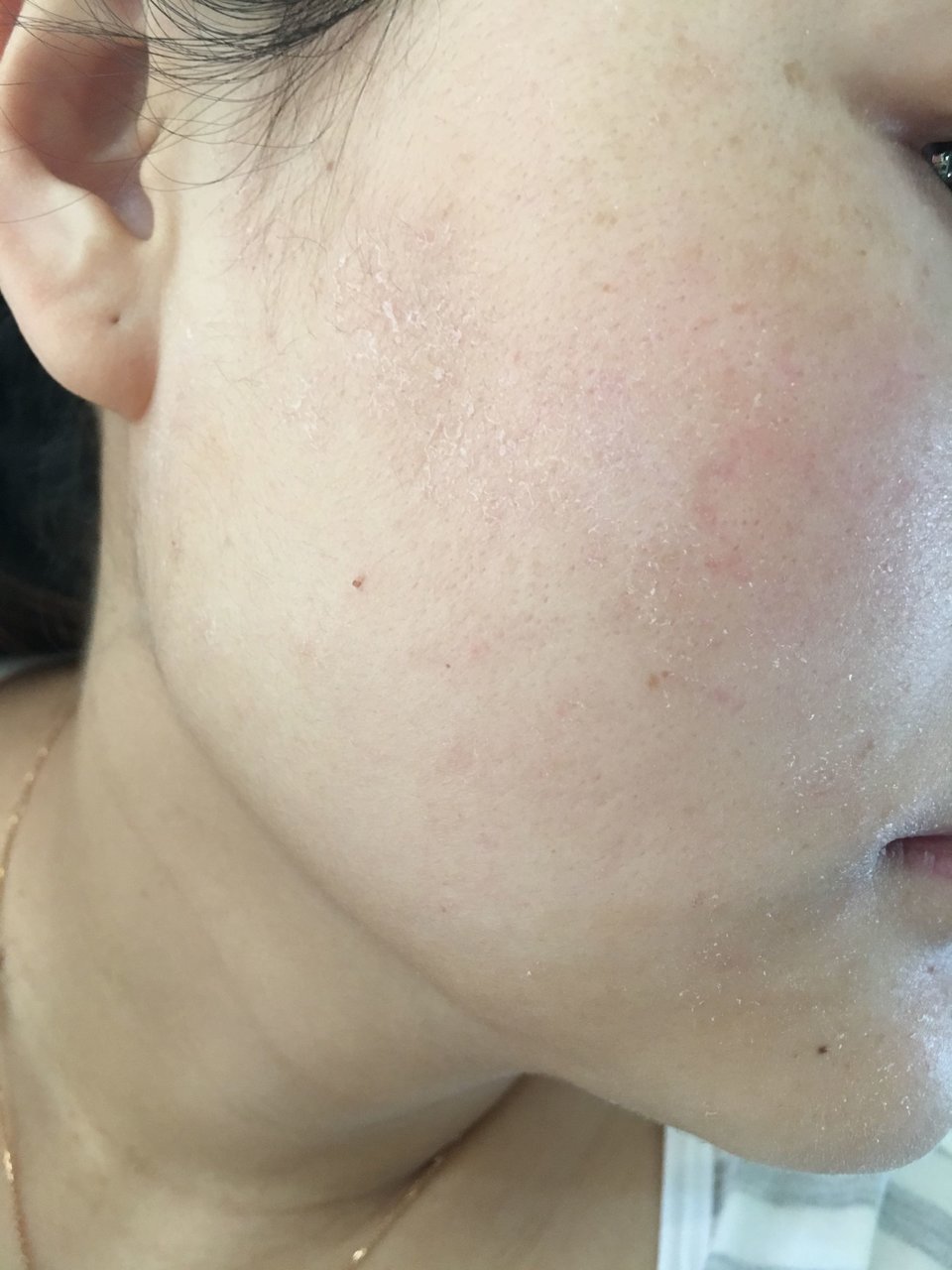 求助😭产后脸上脱皮痒痒