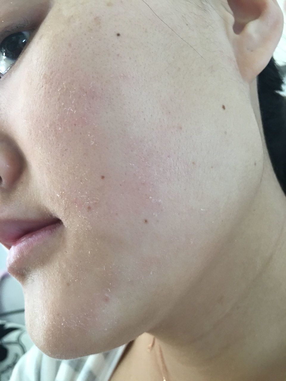 求助😭产后脸上脱皮痒痒