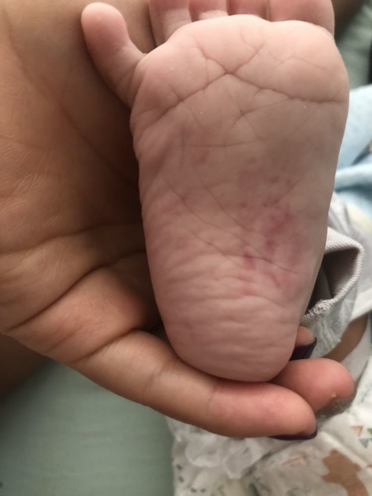 4个半月宝宝，脚底有点红宝妈看看怎么回事