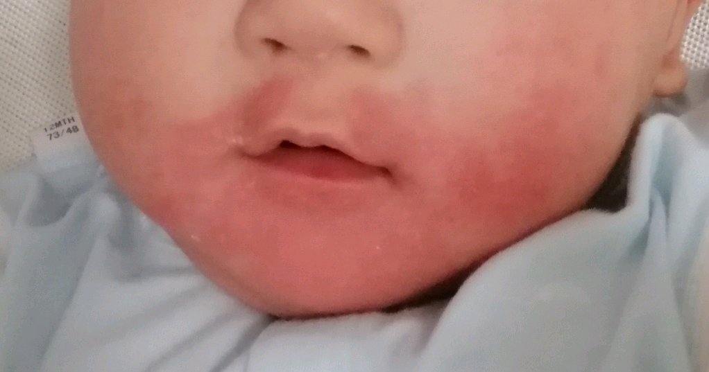 五个月宝宝吃小馒头过敏
