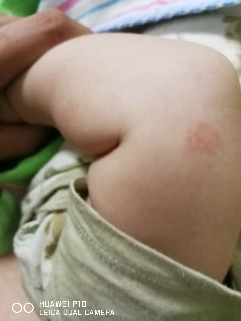 宝宝胳膊肘长了这种东西是什么啊，摸起来表面有点硬