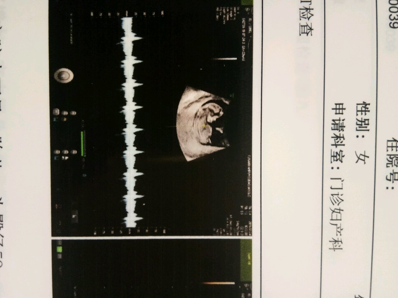 nt12周，nub看男孩女孩，求懂的大家帮忙看一下，谢谢