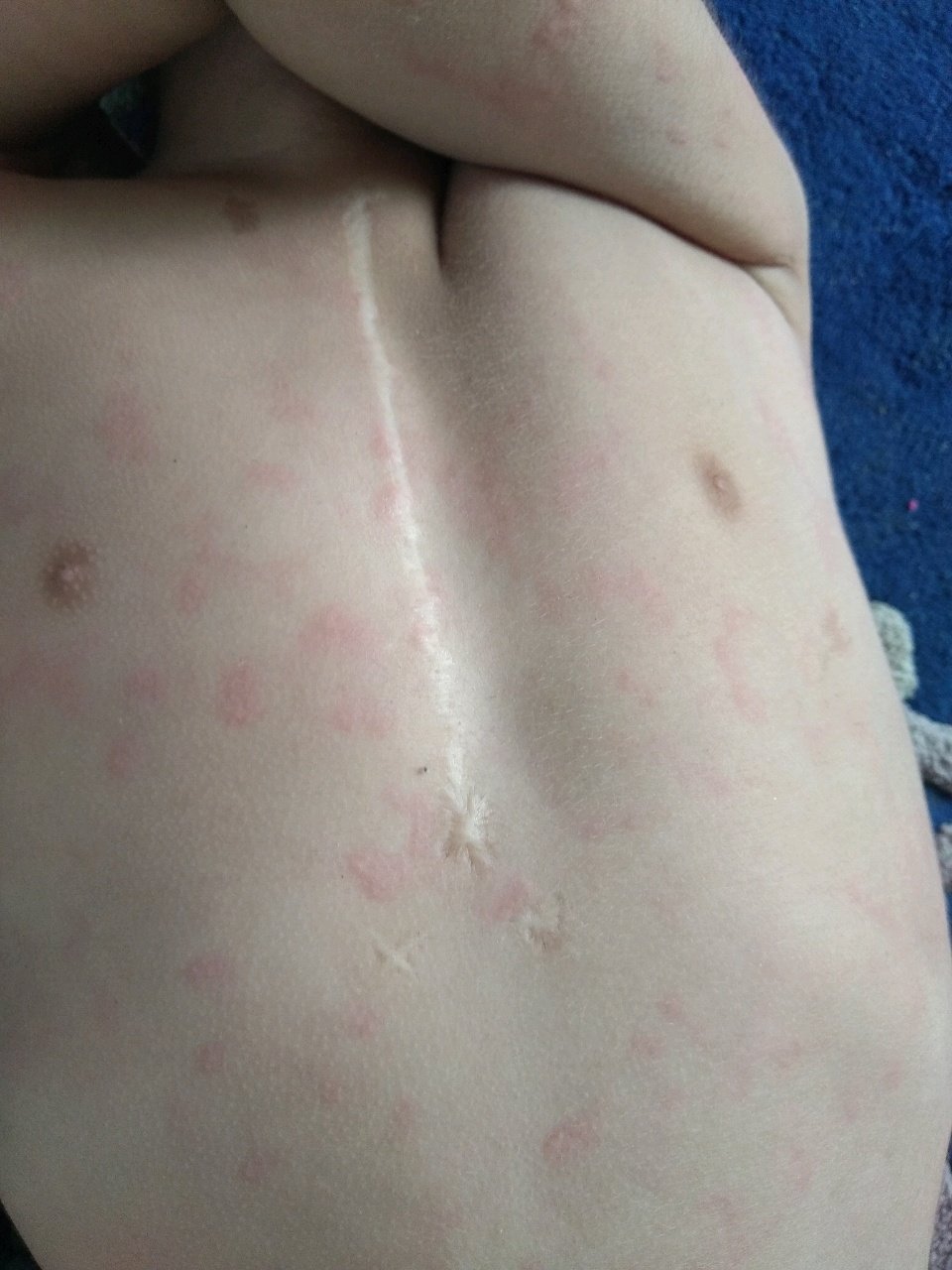 孩子身上起包了怎么办，