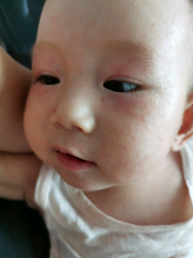 7个月的宝宝得了幼儿急疹