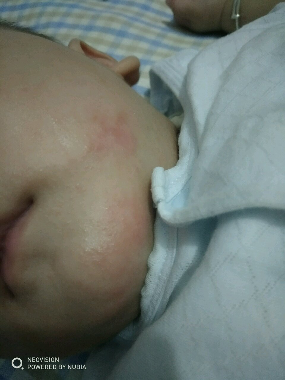这是湿疹吗，抹什么药膏管用啊，谢谢大家