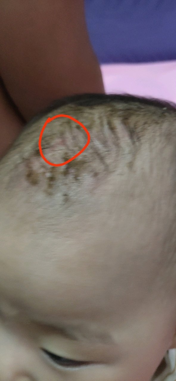 八个月宝宝把自己卤门抓破了