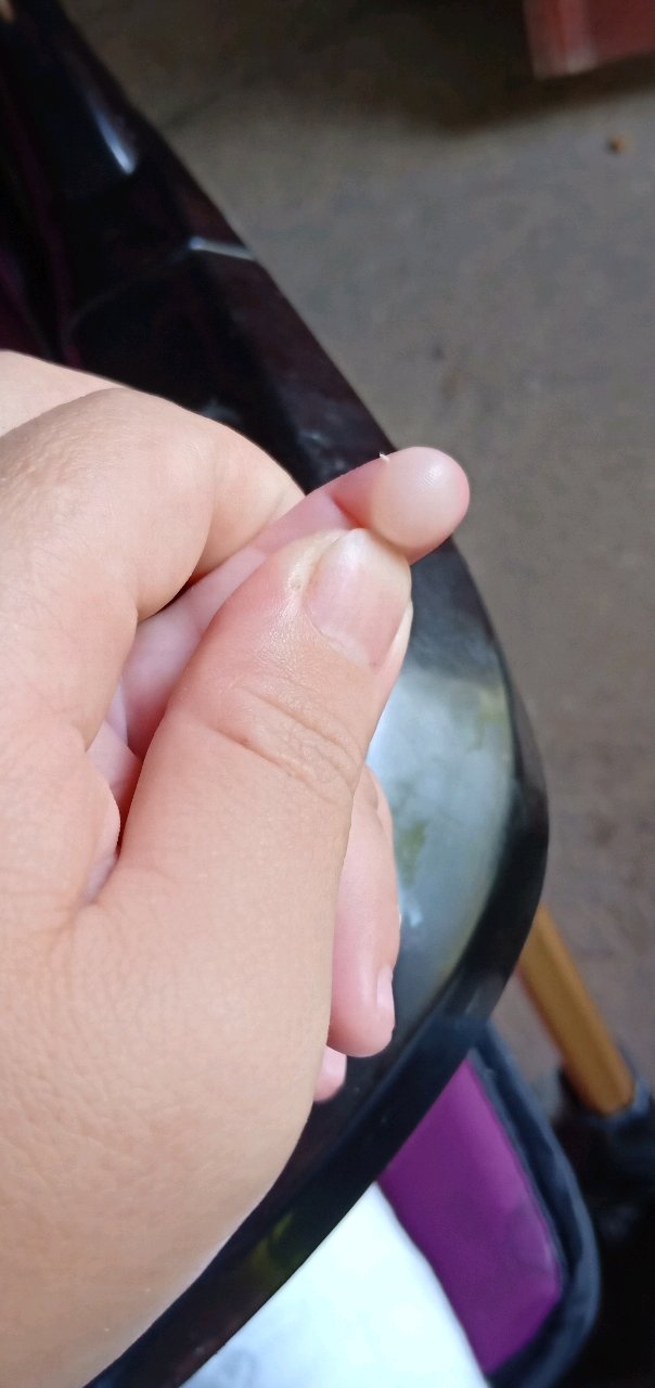 不小心把宝宝给烫伤起泡了
