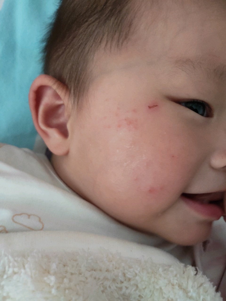 求助宝妈们，红疙瘩