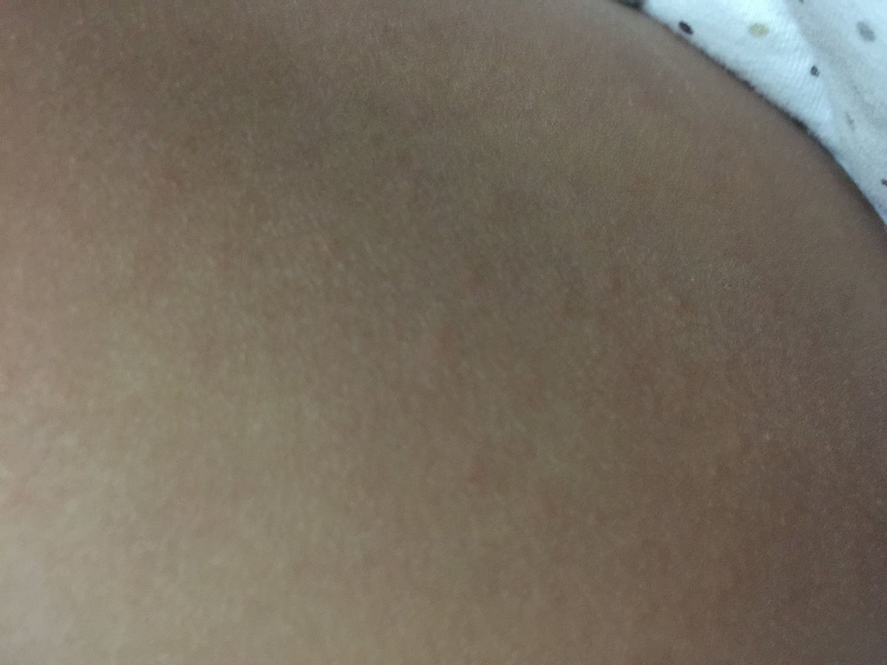 请问这是湿疹吗