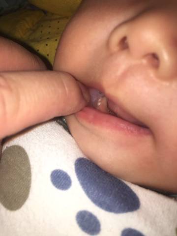 婴儿口腔长马牙图片图片