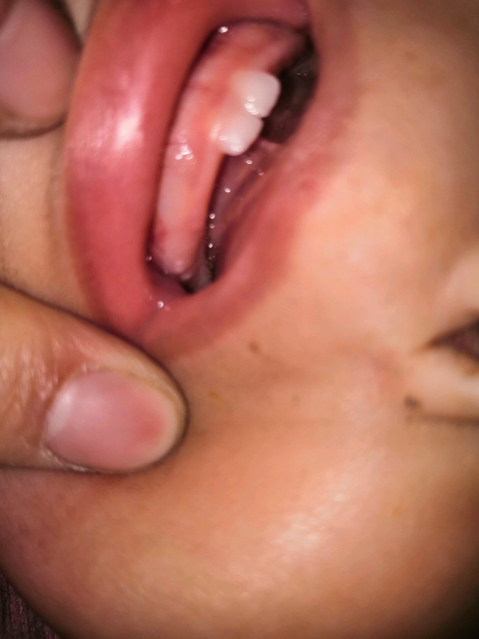 一岁宝宝牙床上有白点