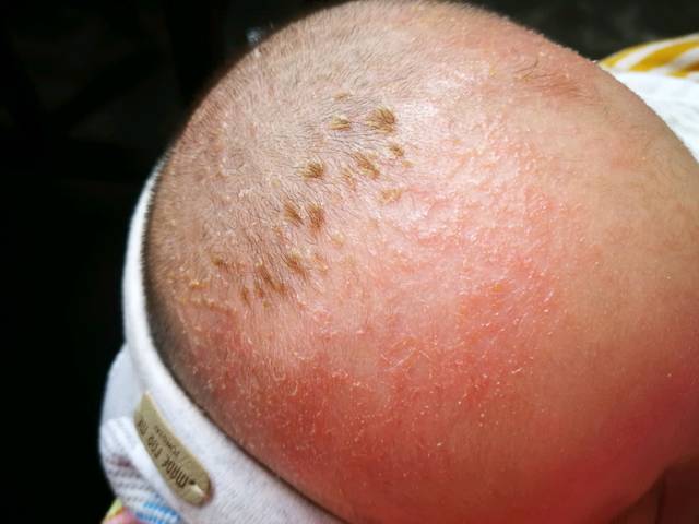 宝宝起湿疹的症状图片图片