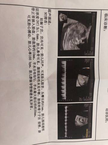 刚做完nt,通过单子能看出男女吗,大神指点