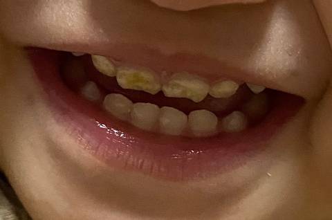一周宝宝牙齿缺钙图片图片