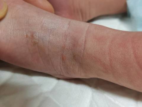 新生儿宝宝生出来三天去洗澡发现腿上结痂了(图一),去医院开了药涂了