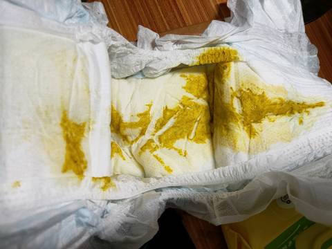 两个月零10天的宝宝拉肚子拉了15天了,去医院做大便常规是病毒性肠炎