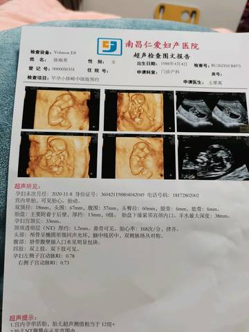 怀孕12周胎儿彩超图片图片