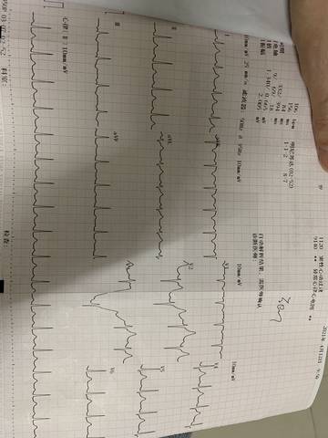 看不懂心电图.右上角写异常.这是什么问题