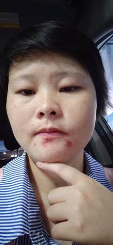 怀孕上火了长痘痘各位宝妈怎么办 没有什么方法推荐一下吗