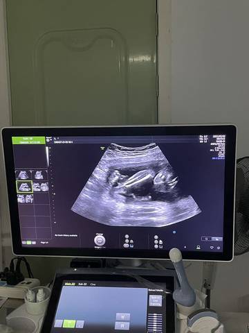 怀孕2周彩超图图片