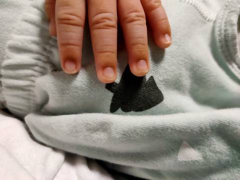 37天宝宝手指头发黑怎么回事