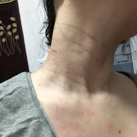 就开始痒,慢慢的一挠就起红坨,结痂了也痒,痒2周多了,医生就说过敏了