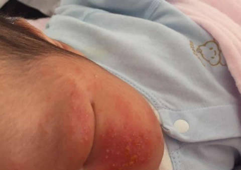 婴儿面上长了很多小红点,这怎样处理_育儿问答_宝宝树