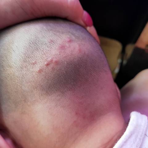 宝宝五个月14天了 不知道怎么回事 后脑勺长了几个痘痘 