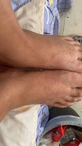 脚上起这种红色的小疙瘩,又痛又痒,怎么办