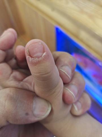 宝宝大指姆这样,有谁知道什么情况,谢谢