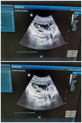 怀孕11周男孩彩超图图片