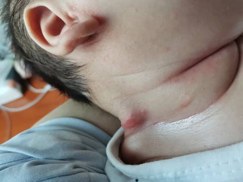 婴儿脖子扁平疙瘩图片图片