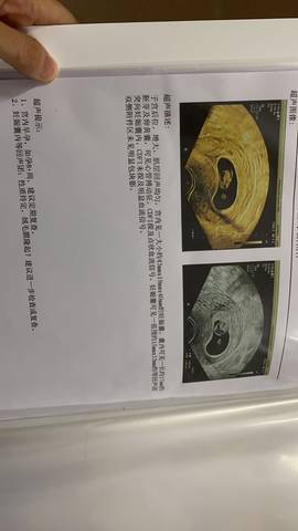 育儿问答 怀孕期 绒毛膜隆起,有人有这种情况吗?