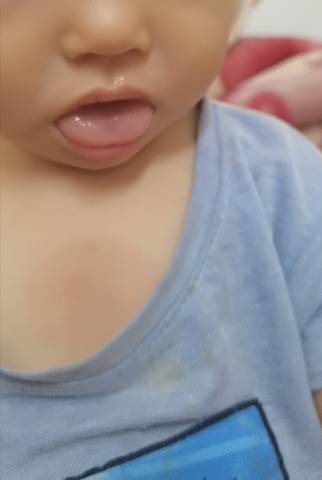 宝宝盼舌的症状图片图片