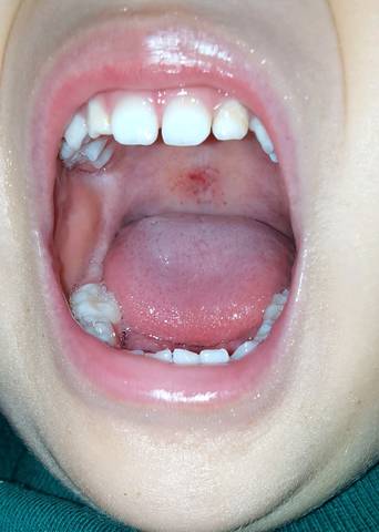 喉咙红和不红图片图片