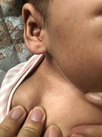 婴儿脖子扁平疙瘩图片图片
