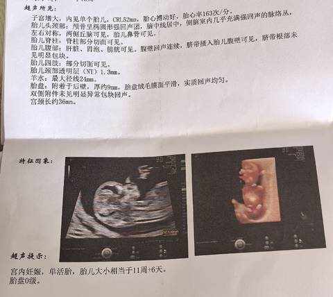 一开始宝宝超活跃，医生让睡觉吧，不然不好检查，幸好一切正常，猜猜蓝粉